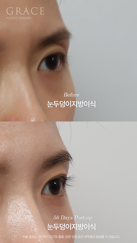 가을 되니 유독 퀭해 보이는 눈가 걱정? 눈두덩이 지방이식 56일차 관련 이미지 6