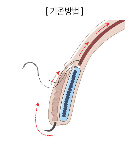 재발한 안검하수 그레이스성형외과에서 해결! 관련 이미지 4