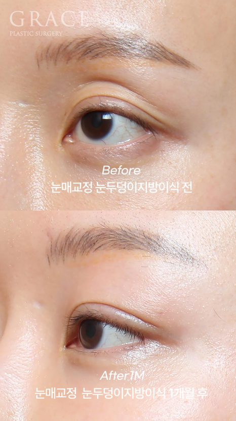 눈두덩이 지방이식 부작용 걱정된다면? 아이홀 지방이식 전후 30대 안와지방이식 관련 이미지 2