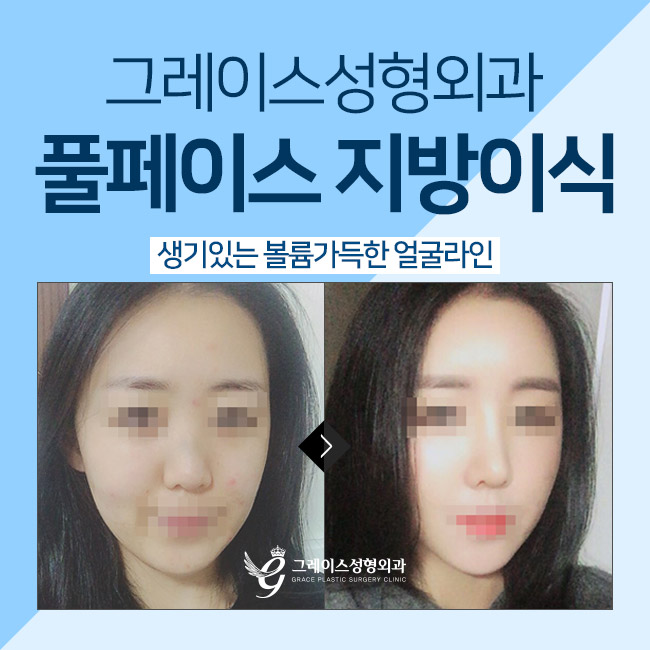 풀페이스지방이식으로 생기 있는 볼륨감 관련 이미지 3