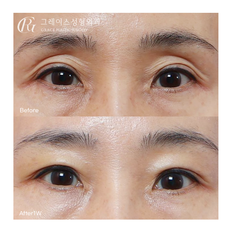 Before and After Eye Hollow Fat Grafting image 1