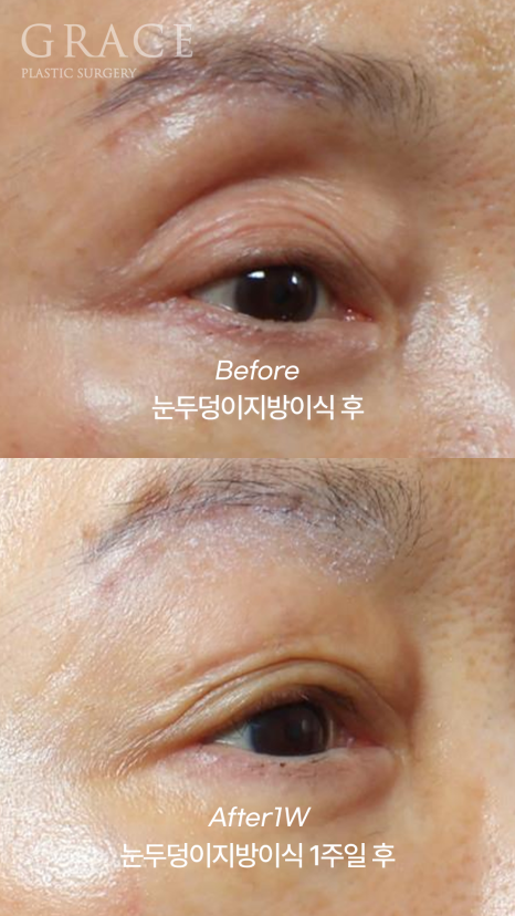 Upper Eye Hollowing and Sunken Brow Bone: Before and After 1 Week of Fat Grafting for a Patient in Her Mid-70s image 8