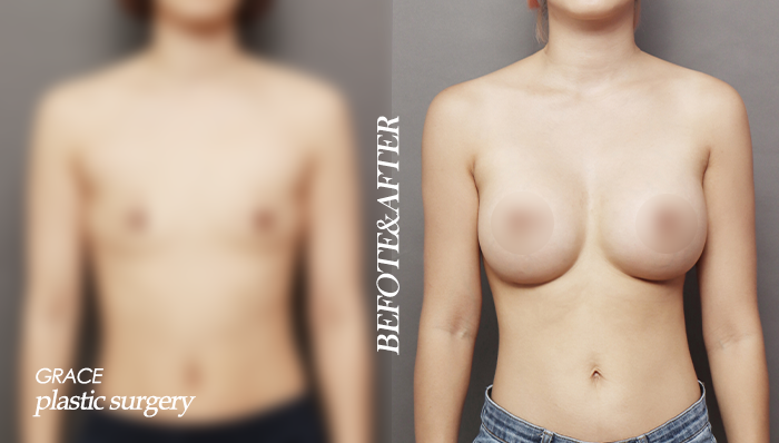 Why Are the “UU Line” and “Vertical Redraping” Important in Breast Surgery? image 2