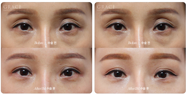 After eyelid fat grafting, do scars remain when you close your eyes? One week later... is this a failure? image 4