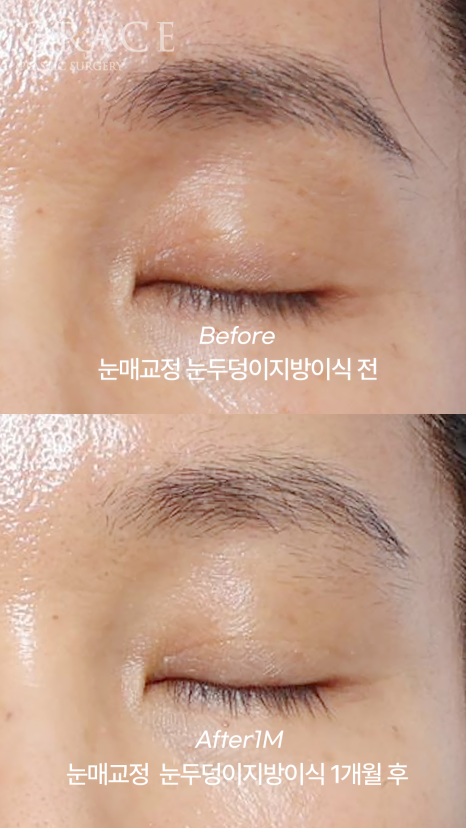 50대 절개눈매교정과 눈위지방이식 붓기는 얼마나 가나요? 관련 이미지 3
