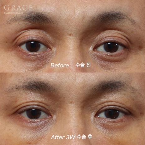 In Your 50s, Restoring a Youthful Look with Before-and-After Eye Surgery and Fat Grafting to the Upper Eyelids, Temples, Under-Eyes, and Above the Brows image 12