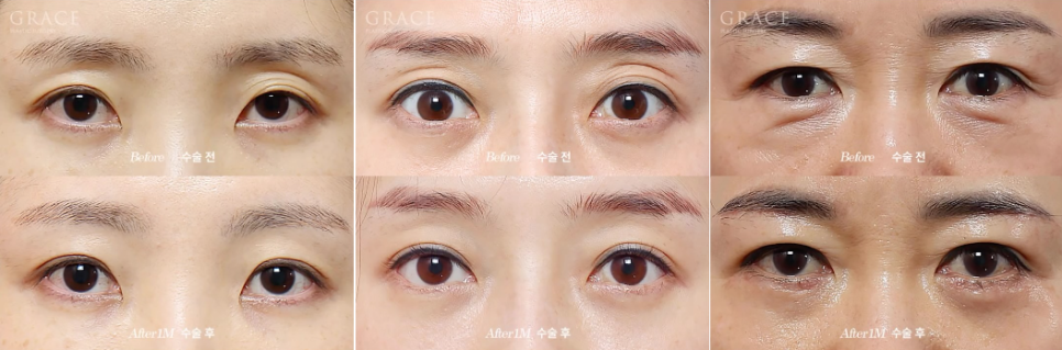 Why Does Fat Grafting to the Upper Eyelids Require a Different Approach from the Lower Eyelids? image 4