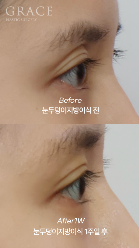 Recovery Timeline Before and After Eyelid Orbital Fat Grafting: 1 Week image 4