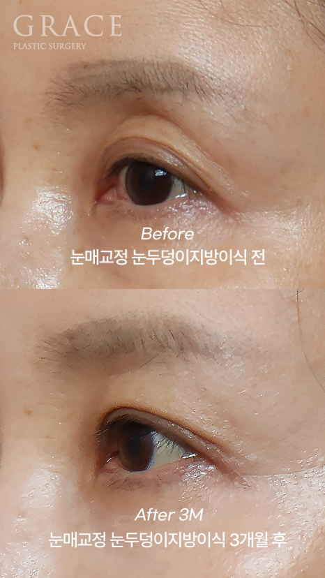 눈꺼풀 지방이식 생착률이 관건이라고? 1개월 회복의 과정 관련 이미지 7