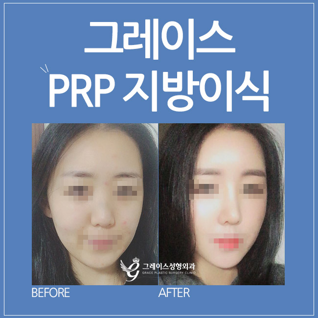 신사역 지방이식잘하는곳, 그레이스성형외과 PRP지방이식 관련 이미지 4