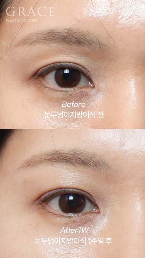 눈두덩이 지방이식 가격보다는 주입방식 관련 이미지 3