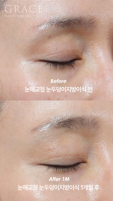 What Is the Problem with the Side Effects of a Lumpy Eyelid Fat Graft? image 3