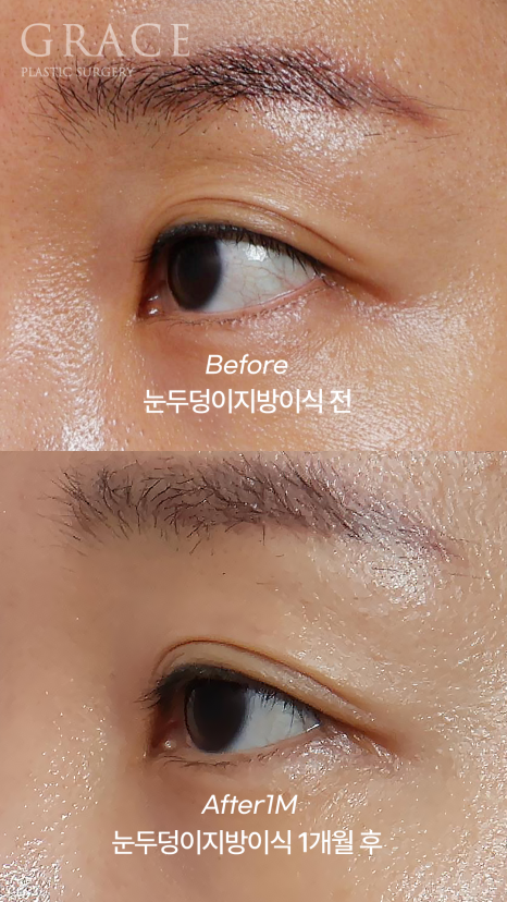 …The Result of Eyelid Fat Grafting (If You’re Worried About Side Effects and Swelling) image 3