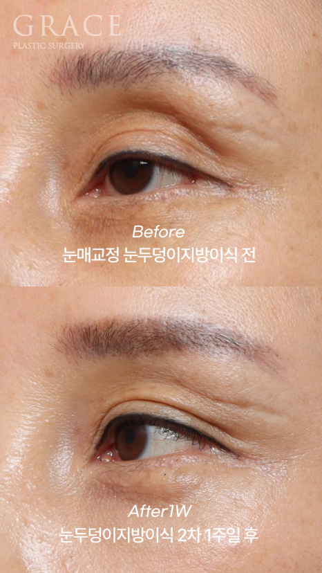 눈두덩이지방이식 2차 이식(리터치) 마취&지방채취 부위 등 관련 이미지 6