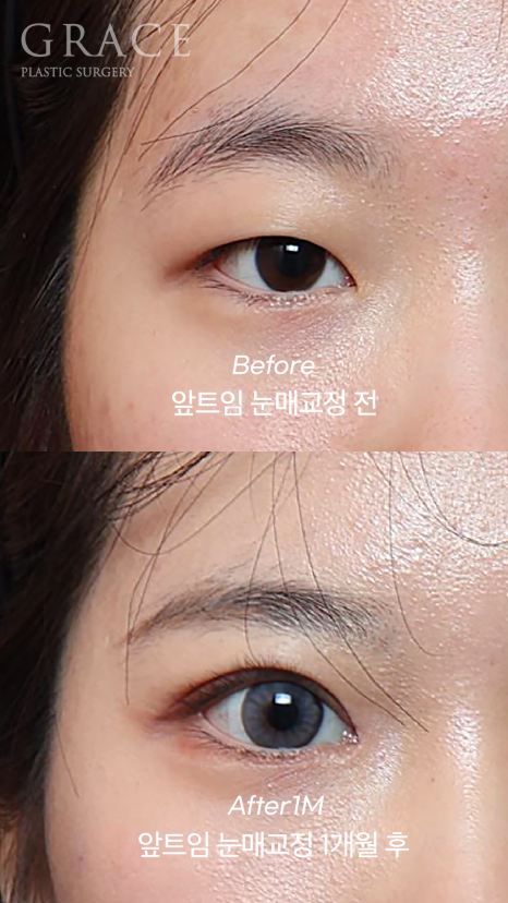 개강 후 난리 났다! 20살 눈매교정 앞트임 전후 관련 이미지 4