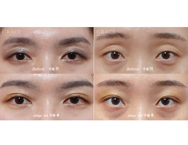 Recovery Timeline Before and After Eyelid Orbital Fat Grafting: 1 Week image 9