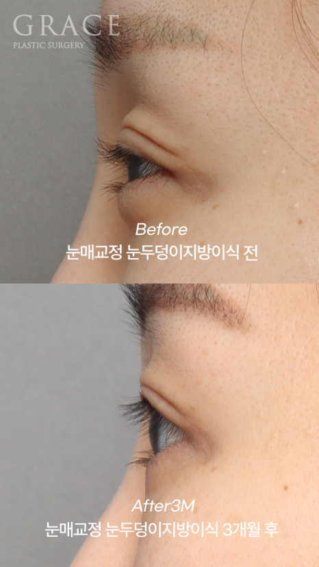 실패한 돌출눈성형 (눈매교정과 눈두덩이 지방이식) 관련 이미지 4