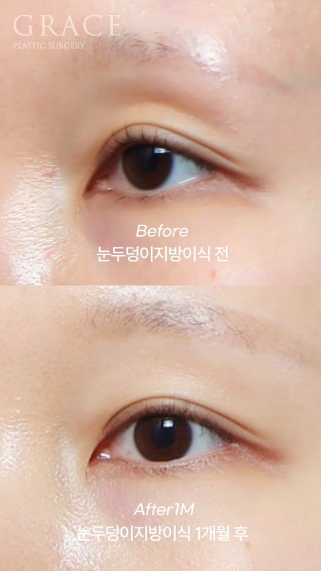 아이홀 꺼짐? 필러 말고 눈꺼풀 지방이식으로 해결했어요 (지방뭉침 없이) 관련 이미지 8
