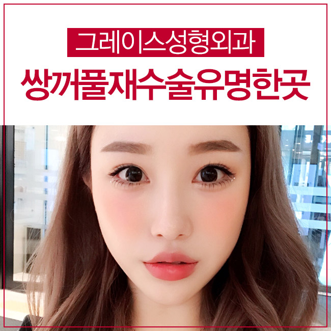 쌍꺼풀재수술유명한곳을 알아본다면? 관련 이미지 4