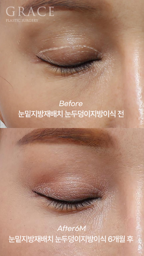 Eye Surgery for People in Their 50s That Reduces Time, Cost, and Recovery: Upper Eyelid Fat Grafting & Under-Eye Fat Repositioning image 5