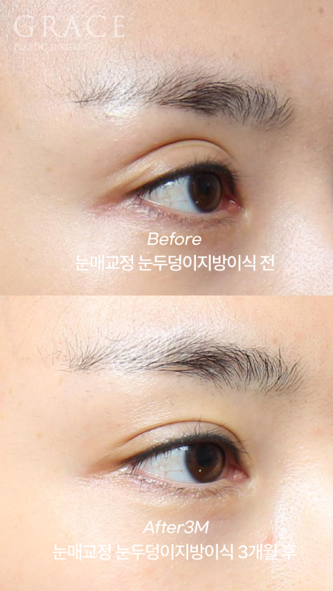 눈꺼풀지방이식+눈매교정 1주일 차 붓기&middot;노란 멍 그 후 3개월 관련 이미지 5