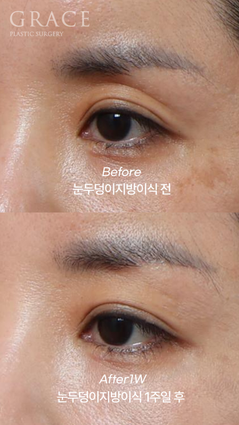 Week 1 After Upper Eyelid Fat Grafting in the Mid-40s: A Natural Return Without Swelling image 9