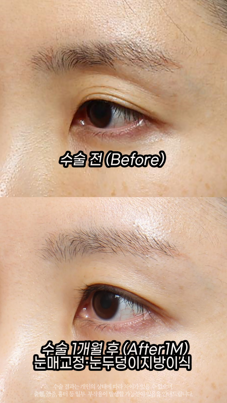 If Sunken Eyelids Are Left Untreated, About Hollows in the Eye-Hole Area (Fat Grafting) image 2