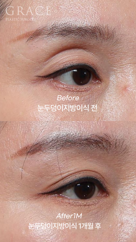 Upper Eyelid Fat Grafting Cost · Swelling, Reviews & Side Effects image 5