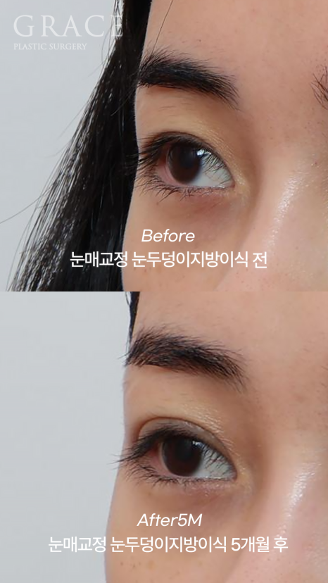 (2차 냉동지방 NO) 생지방으로 자연스럽게 채운 눈두덩이  붓기/부작용 걱정 없이 관련 이미지 6