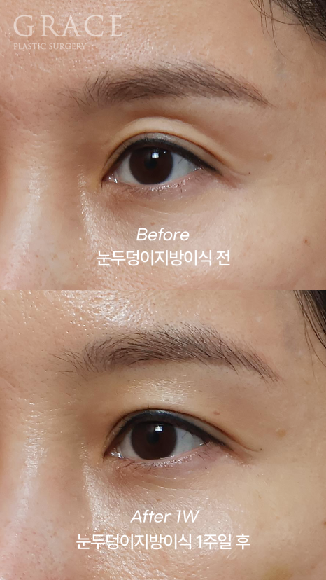 One-Week Changes After Eyelid Fat Grafting: Sunken Eye Hollows Regain Volume image 9