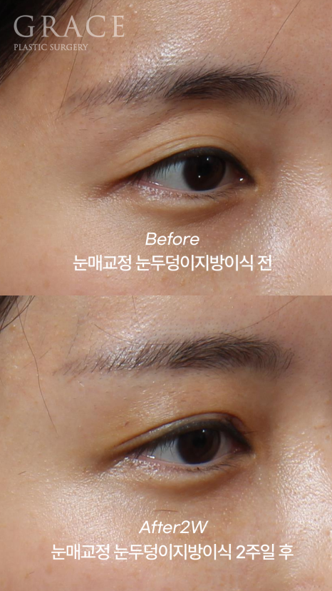 30대 눈두덩이 지방이식 + 눈매교정 + 눈밑지방재배치 BEFORE & AFTER 관련 이미지 4