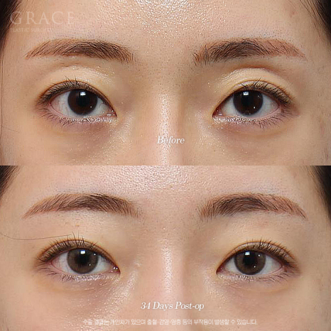 눈두덩이 지방이식이 필요한 경우 진료실에서는 무엇을 볼까요? 관련 이미지 2