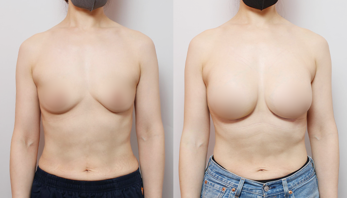 Considering Breast Augmentation Options? A Comparison of Dual Plane vs. Tissue-Preserving (Partial Subfascial) Techniques image 1