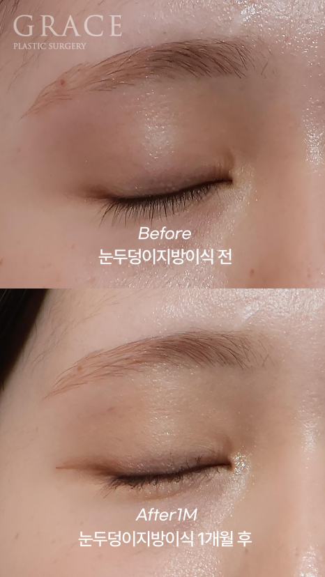 In Your Mid-20s, If You Have Ptosis Before and After Upper Eyelid Fat Grafting, Is Eye Correction Essential? image 3