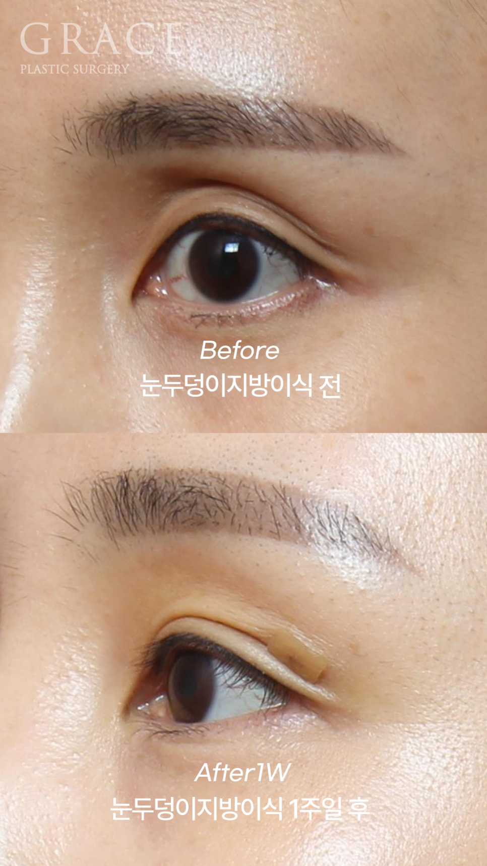 How to Fix a Sunken Eye Hollow: Upper Eyelid Fat Grafting + Ptosis Correction image 6