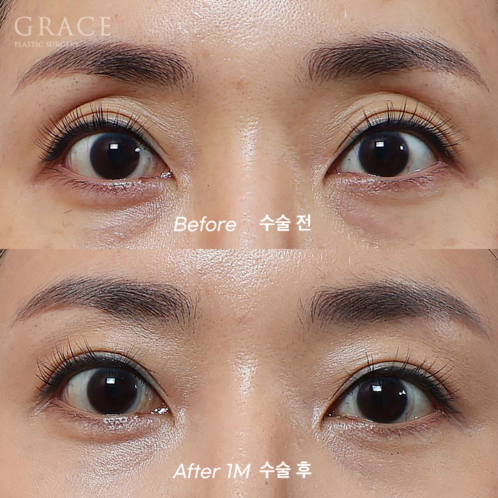 Male Brow Filler? Improvement with Eye-Hole Fat Grafting (Without Worrying About Side Effects, Scars, or Swelling) image 10