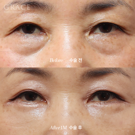 60대 눈밑성형 하안검과 눈밑지방재배치 차이 관련 이미지 2