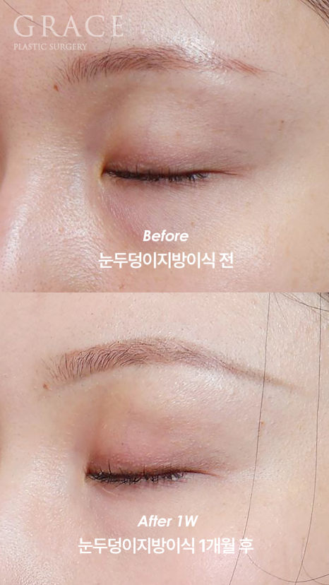 눈을 감았을 때 보이는 멍·흉터·울퉁불퉁함 걱정되나요? 눈두덩이 지방이식 관련 이미지 5