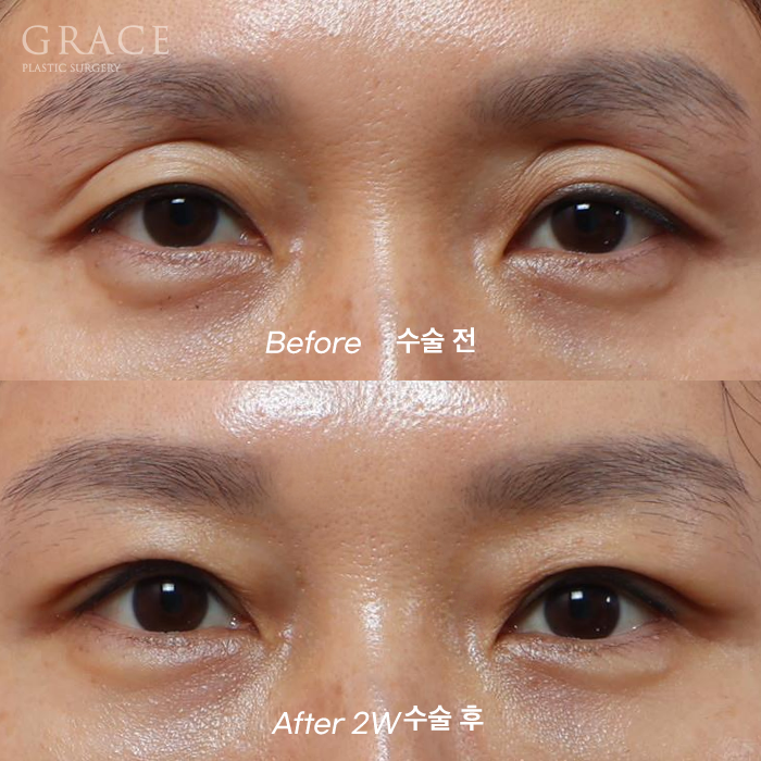 2-Week Swelling Progress After Upper Eyelid Fat Grafting + Incisional Ptosis Correction in Your 40s image 1