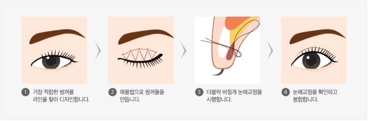 눈매교정은 신사역 그레이스성형외과 더블락비절개눈매교정 관련 이미지 4
