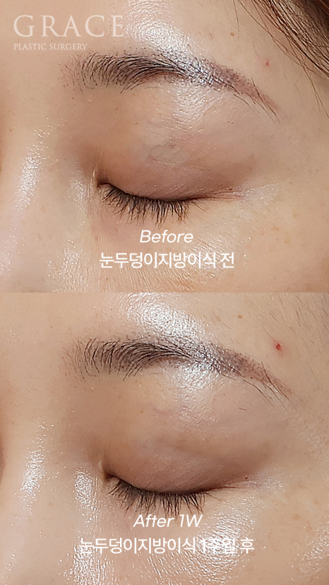 눈 감았을 때 울퉁불퉁? 실제 눈두덩이지방이식 전후 관련 이미지 5