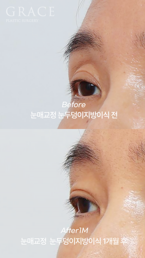50대 절개눈매교정과 눈위지방이식 붓기는 얼마나 가나요? 관련 이미지 5