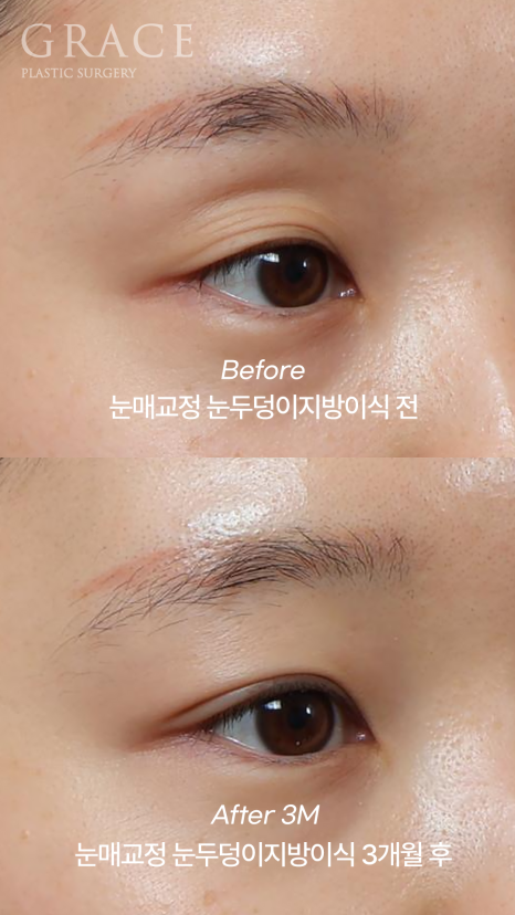 30대 눈꺼풀 꺼짐 교정 눈두덩이지방이식과 비절개눈매교정으로 자연스럽게 복원된 눈매 관련 이미지 4
