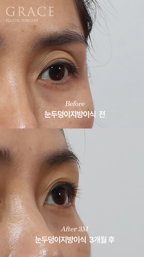 안와지방 주입 &middot; 눈두덩이지방이식 (1cc / 0.9cc) 관련 이미지 7