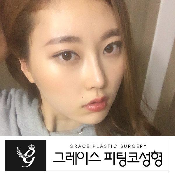 그레이스성형외과 피팅코성형이라면 가능하다! 자유자재로 움직이는 코! 관련 이미지 3