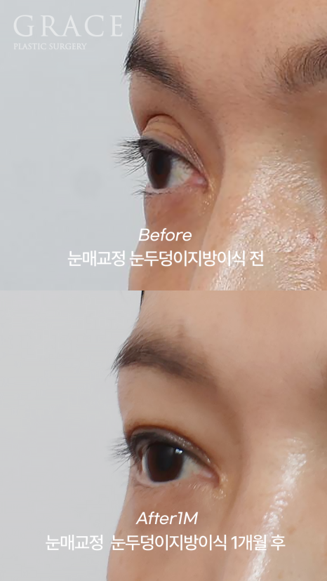 Is Eyelid Fat Grafting in Your 40s Required to Include Ptosis Correction? It Depends on Your Eye Condition image 4