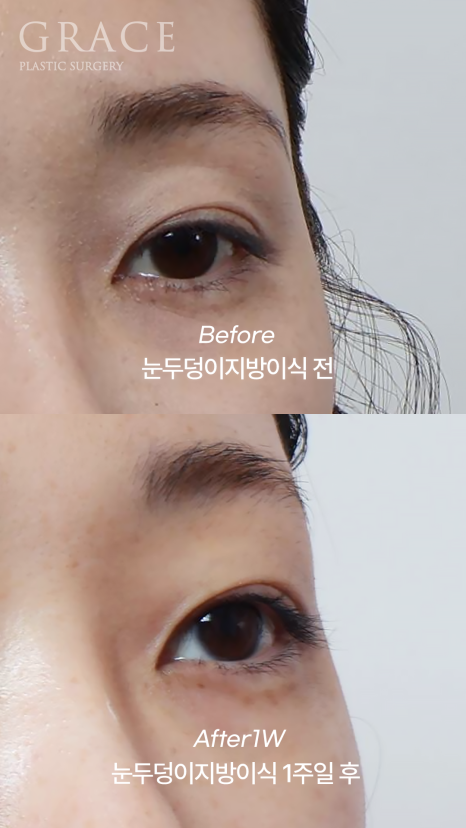 How to Fill Sunken Eyelid Hollows with Fat Grafting (Concerns About Filler Side Effects) image 5
