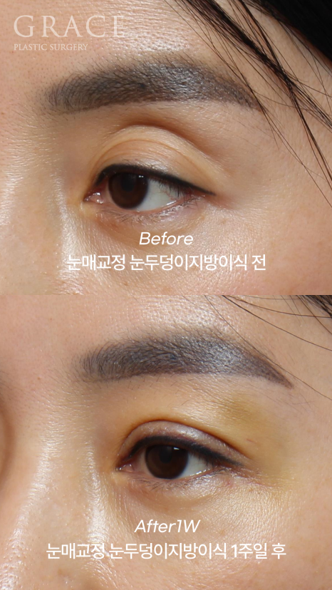 Eye Fat Grafting Instead of Eyelid Filler: Eye Shape Correction (1-Week Swelling Level) image 2