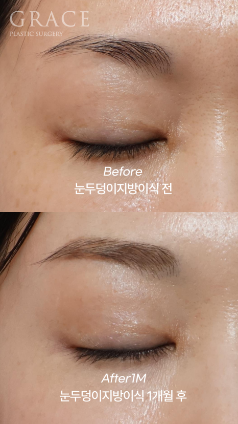 How Long Does Upper Eyelid Fat Grafting Last? The Facts About Maintenance Period image 3