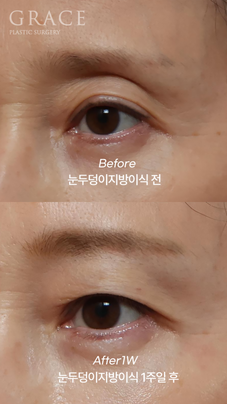 눈두덩이 지방이식 유지기간과 부작용까지 한 번에 정리 관련 이미지 4